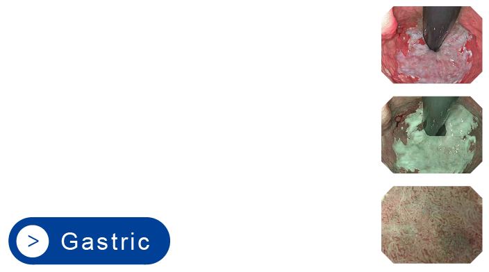 Gastric