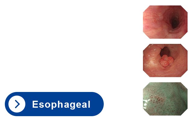 Esophageal