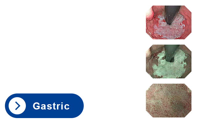 Gastric