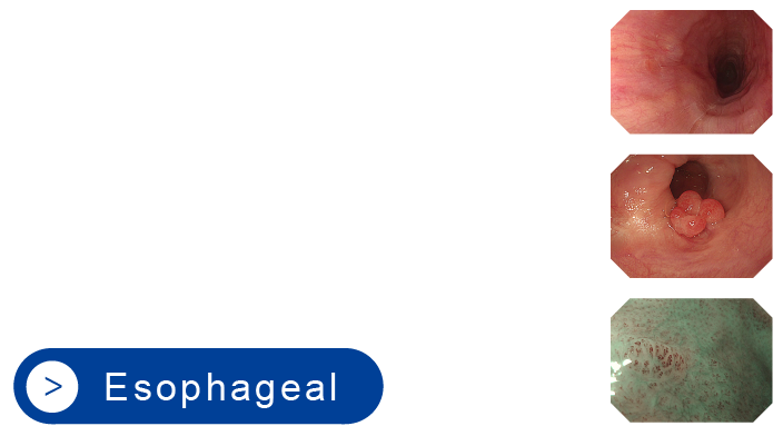 Esophageal