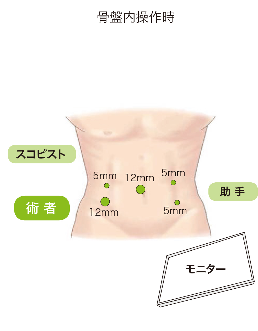 骨盤内操作時