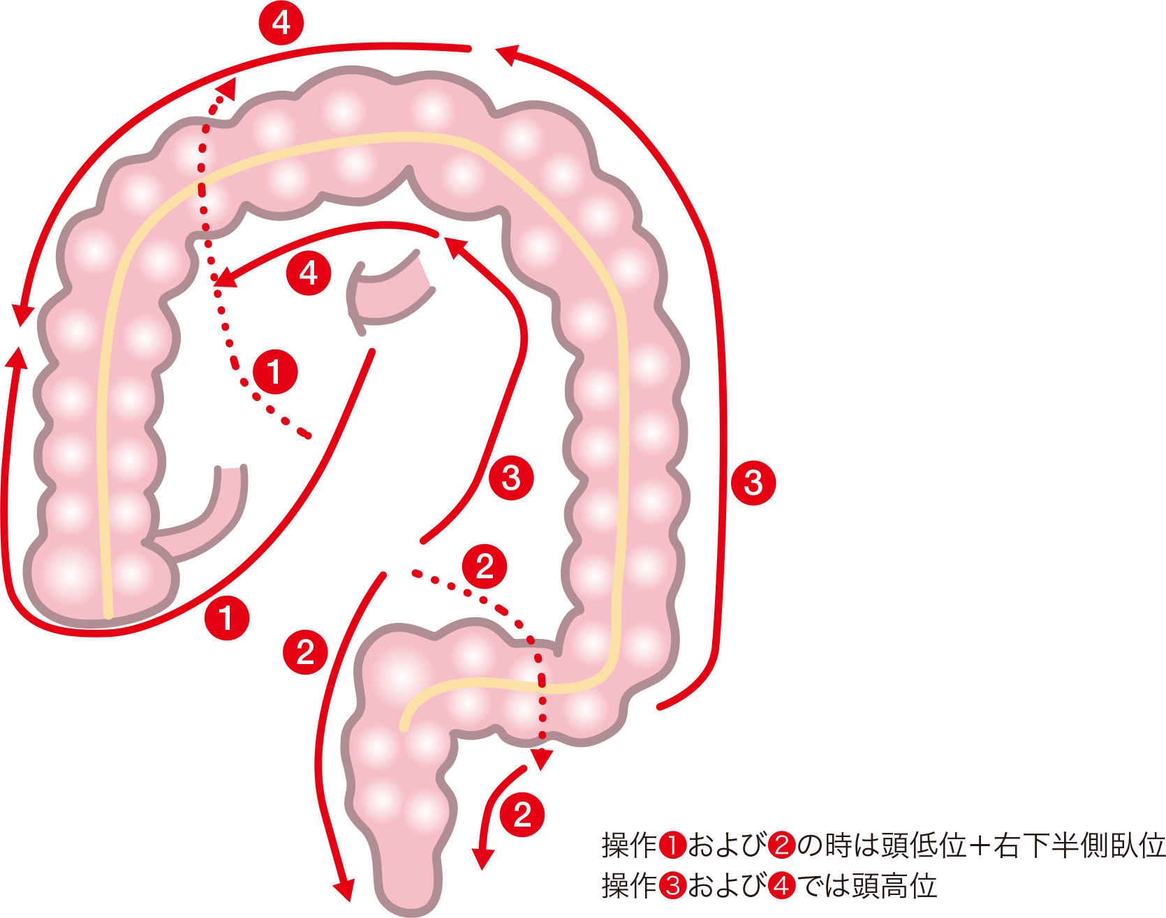 操作❶および❷の時は頭低位＋右下半側臥位操作❸および❹では頭高位