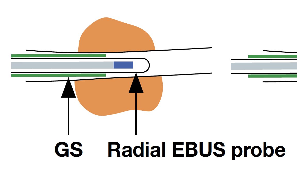 Jornal Brasileiro de Pneumologia - Predictive factors for improved  diagnostic accuracy with the use of radial-probe EBUS