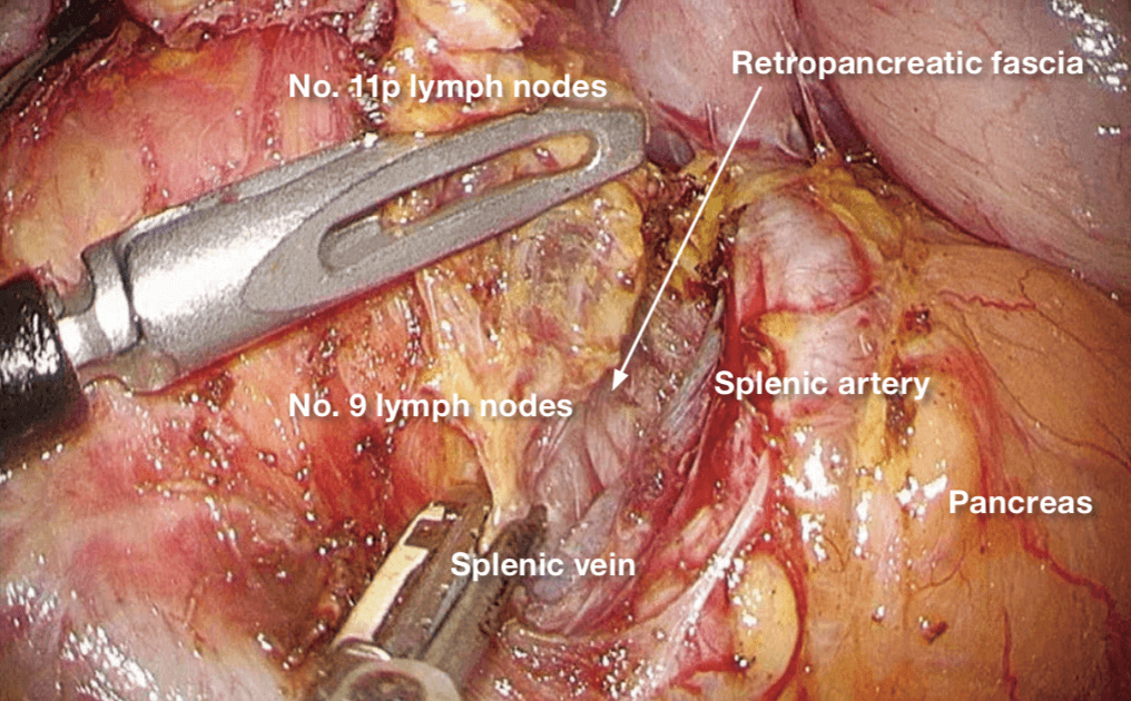 Performed with THUNDERBEAT Laparoscopic distal gastrectomy D2 lymph