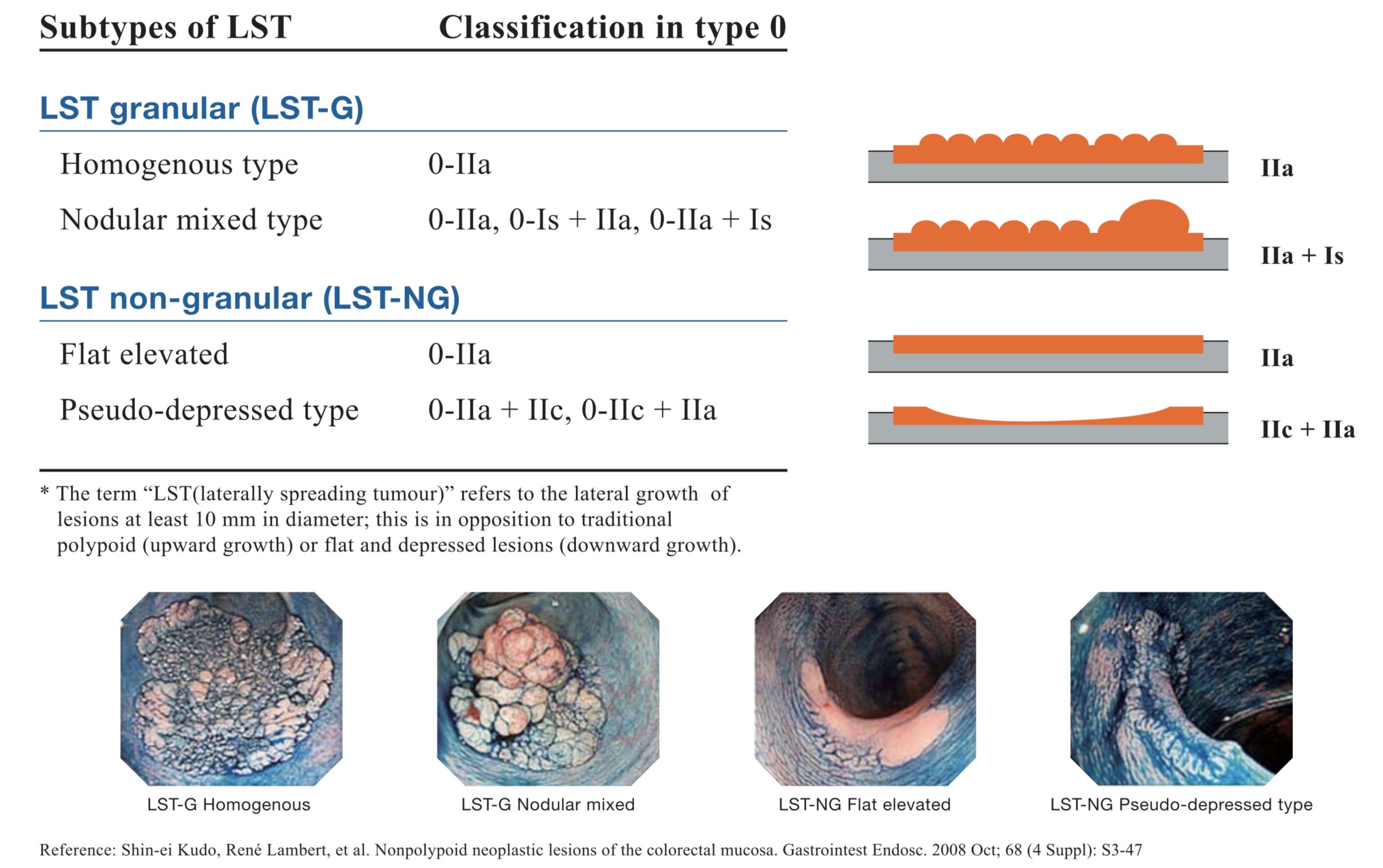 Subtypes of LST* lesions: Morphologic classification of LST lesions and their correspondence in the Paris-Japanese classification