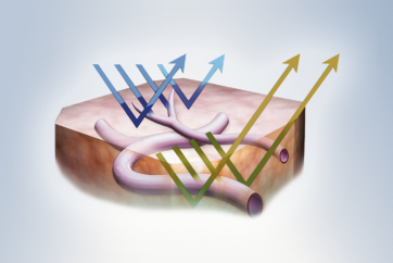 Narrow Band Imaging (NBI)