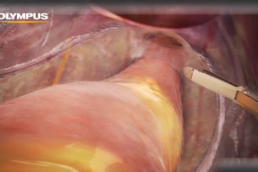 3D Animation Low Anterior Resection - Olympus Professional Education  On-Demand Library