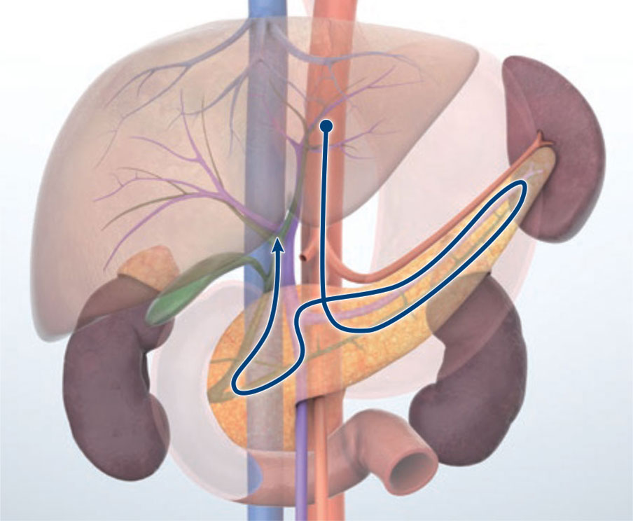 Transgastric approach (aortic route)