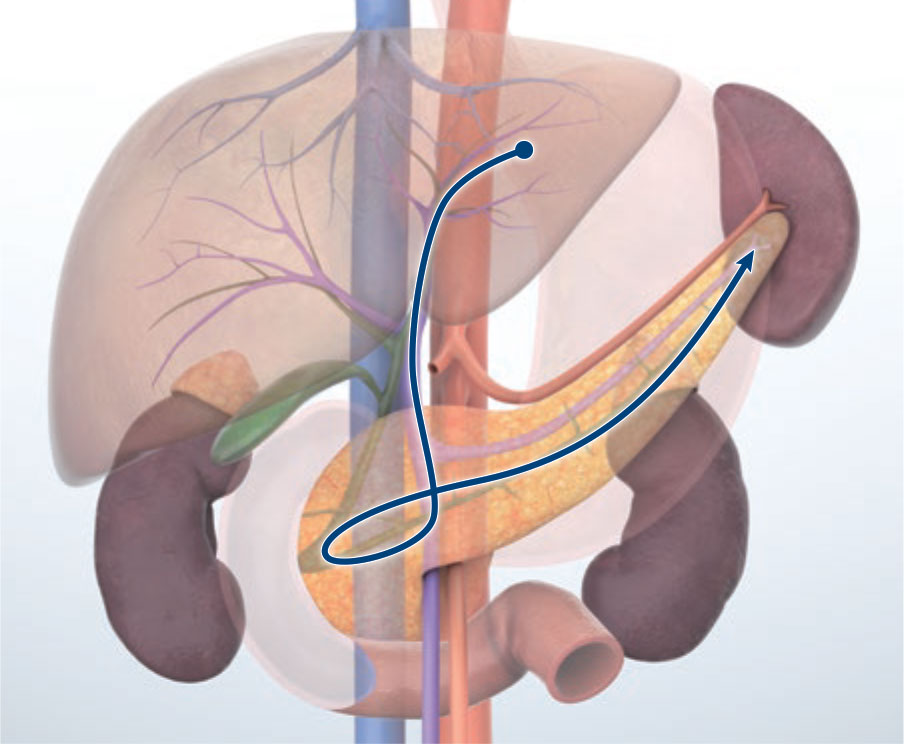 Transgastric approach (portal vein route)