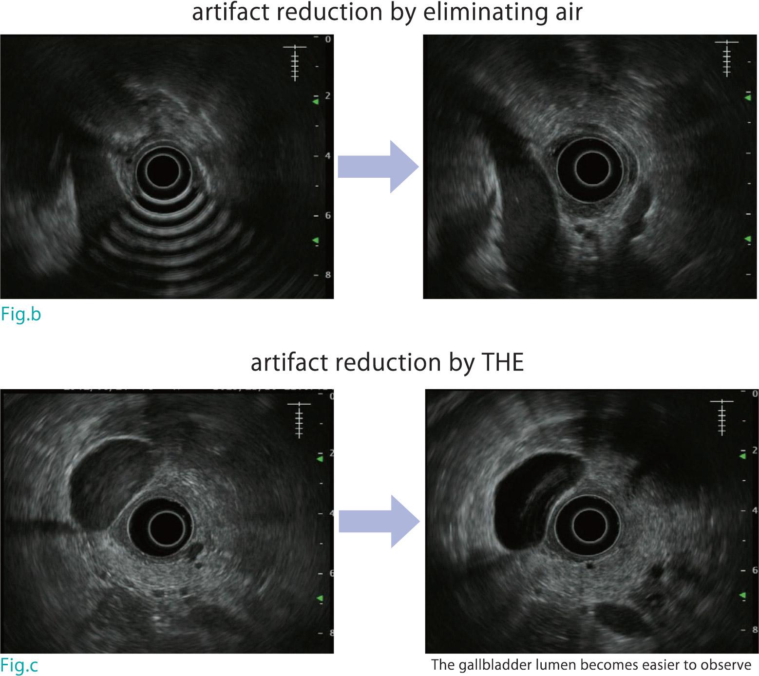 Standard Imaging Methods in the Pancreatobiliary Region Using Radial EUS Olympus Professional