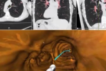 Navigated Bronchoscopy