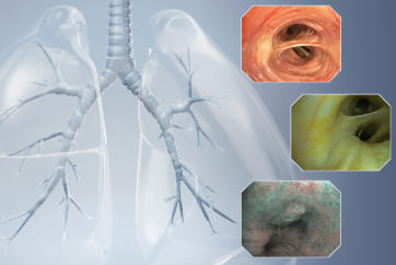 EVIS X1 Respiratory Atlas