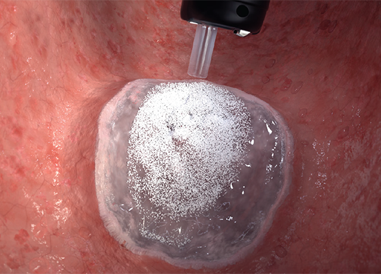 EndoClot® Submucosal Injection Solution (SIS) - Olympus Professional ...